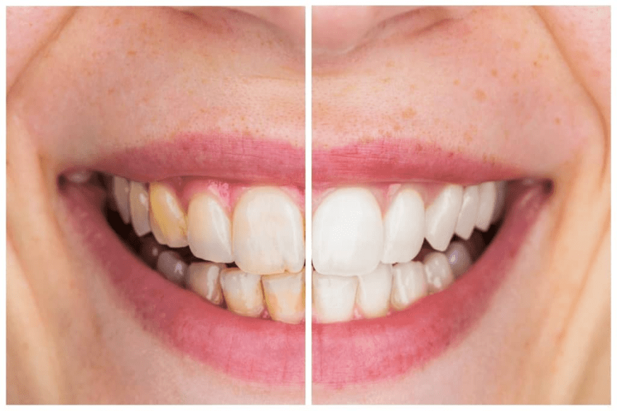 Experience Premium Composite Bonding in Turkey