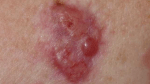 Basal Cell Carcinoma